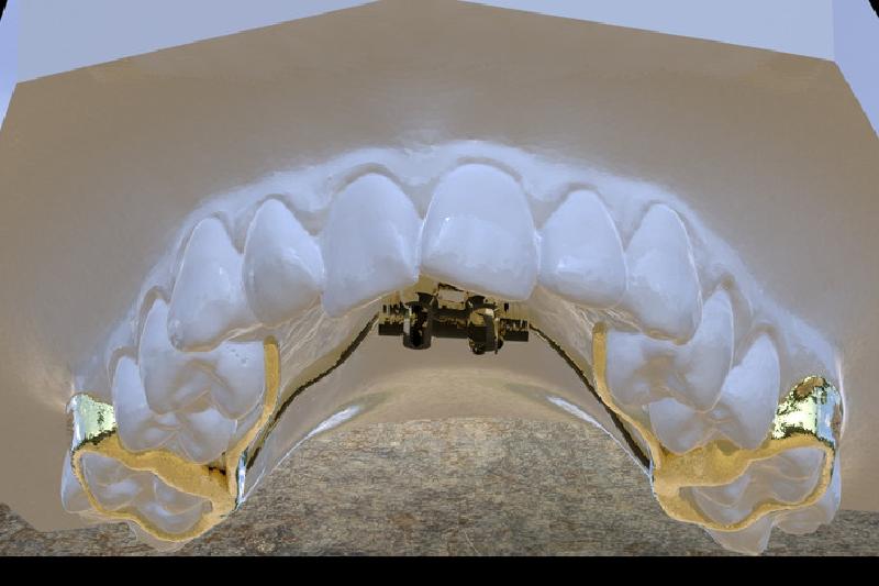 上颚扩展器 (牙齿矫正应用)